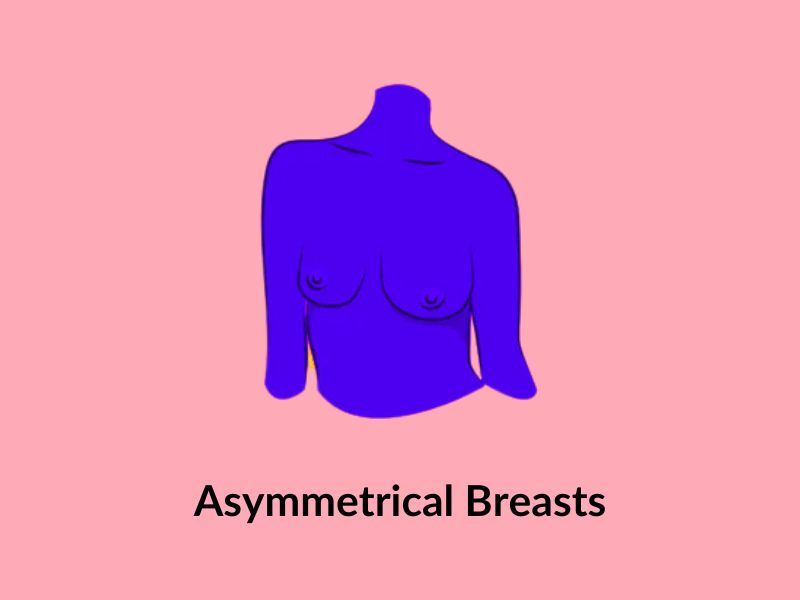 Asymmetrical breasts Asymmetrical breasts