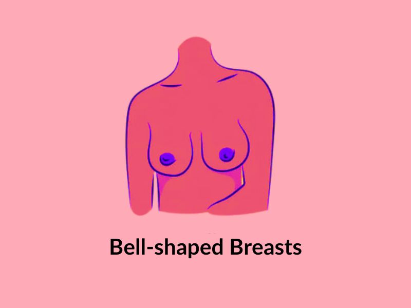 Bell-shaped breasts Bell-shaped breasts