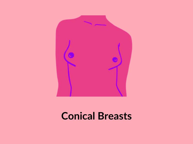 Conical breasts Conical breasts