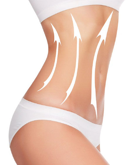 Antalya-liposuction-yag-aldirma