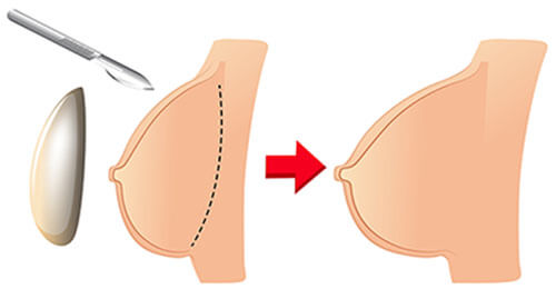 breast-enlargement-Antalya