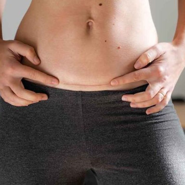 abdominoplasti-riskli-mi